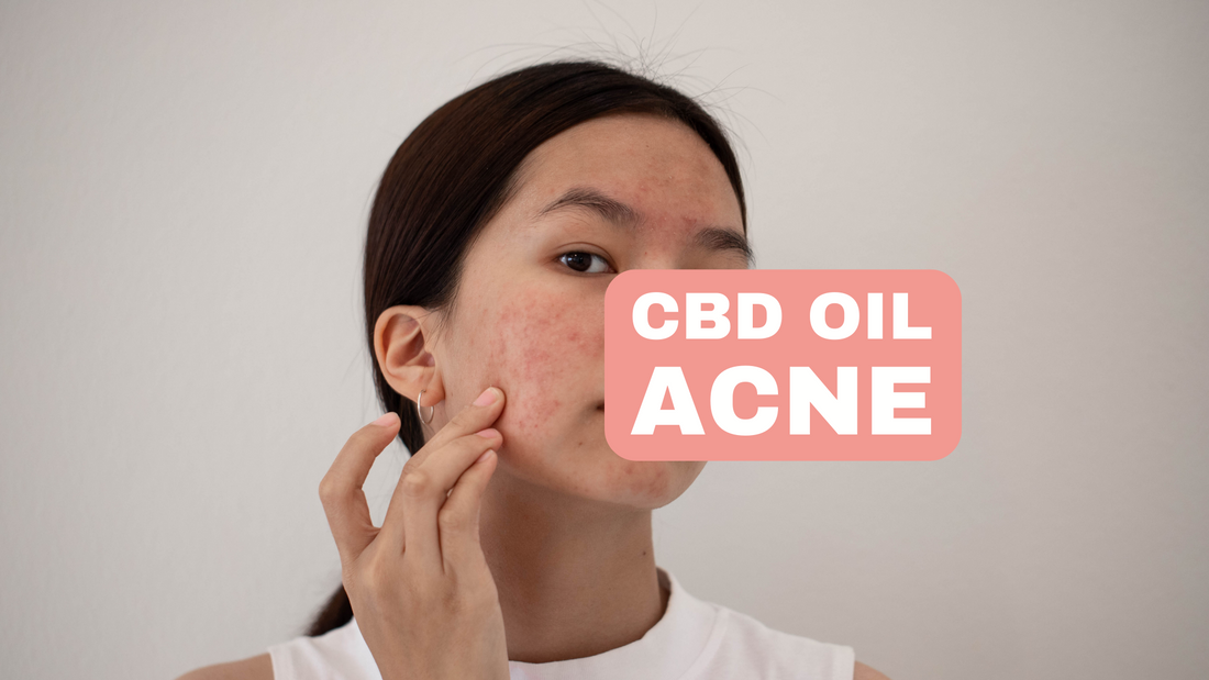 CBD Oil for Acne How Can Cannabidiol Help with Skin Problems and Scars