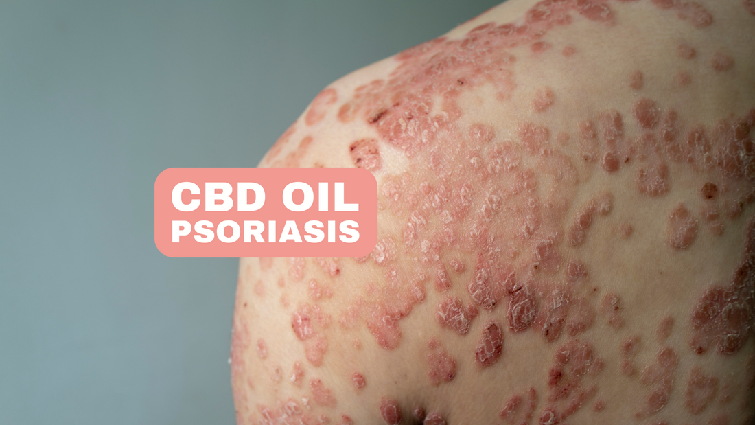 CBD Oil for Psoriasis on Elbows Soothe Irritated Skin