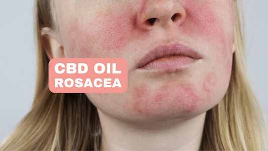 CBD Oil for Rosacea Soothing Irritated Skin